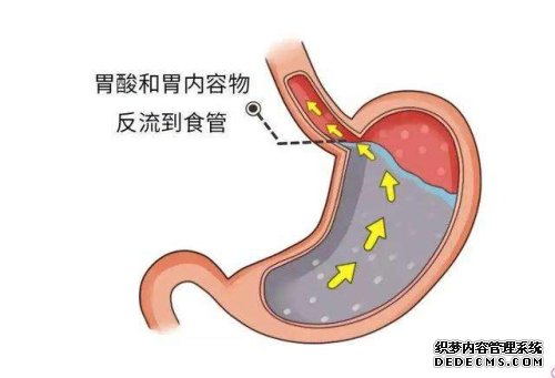 胃食管反流要如何治療